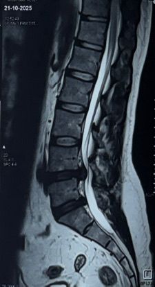 Pre-Op MRI Scan showing herniated disc